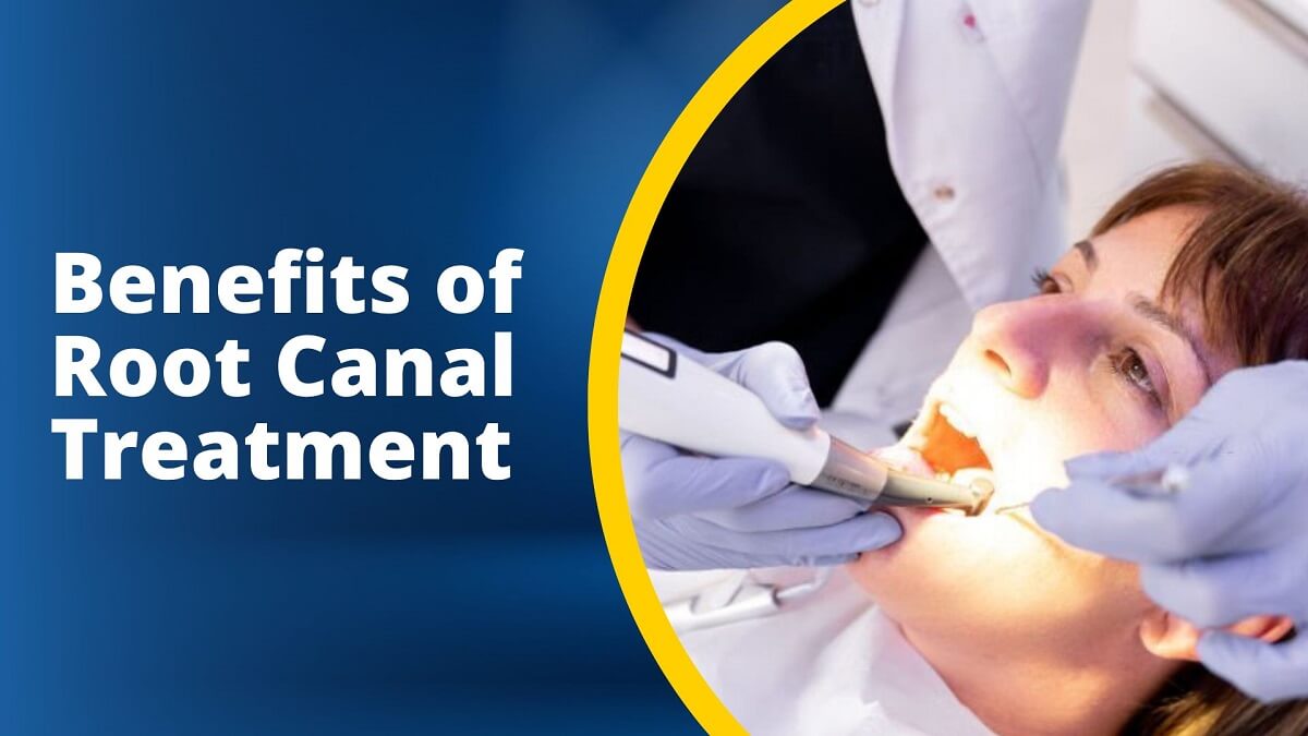Benefits of Root Canal Treatment